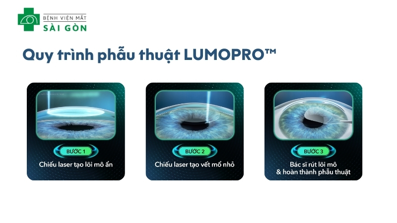 Quy trình Phẫu thuật xoá cận LUMOPRO™