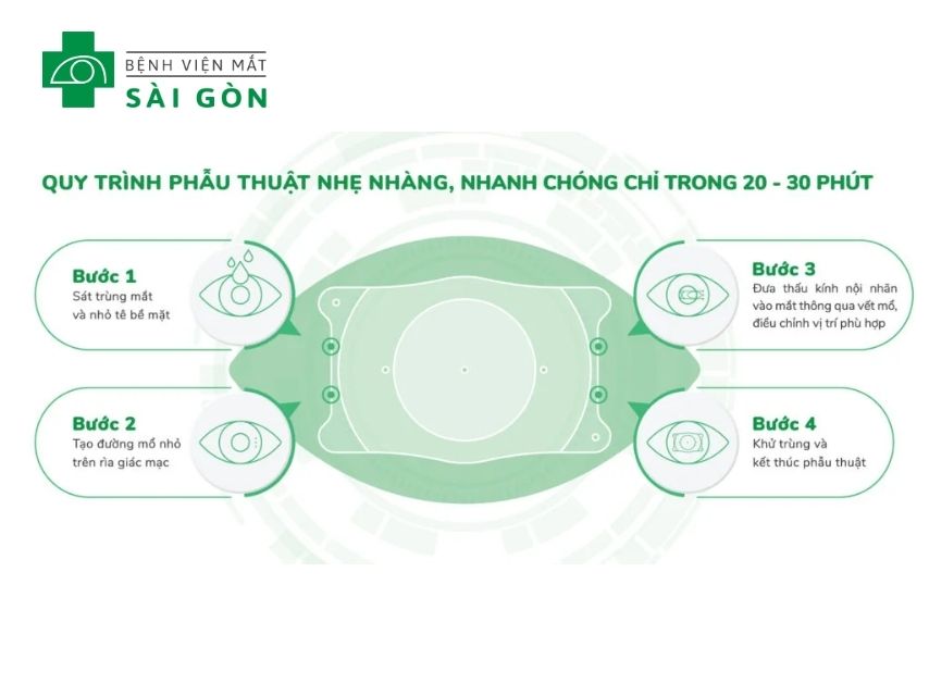 Phẫu thuật PHAKIC trải qua 4 bước