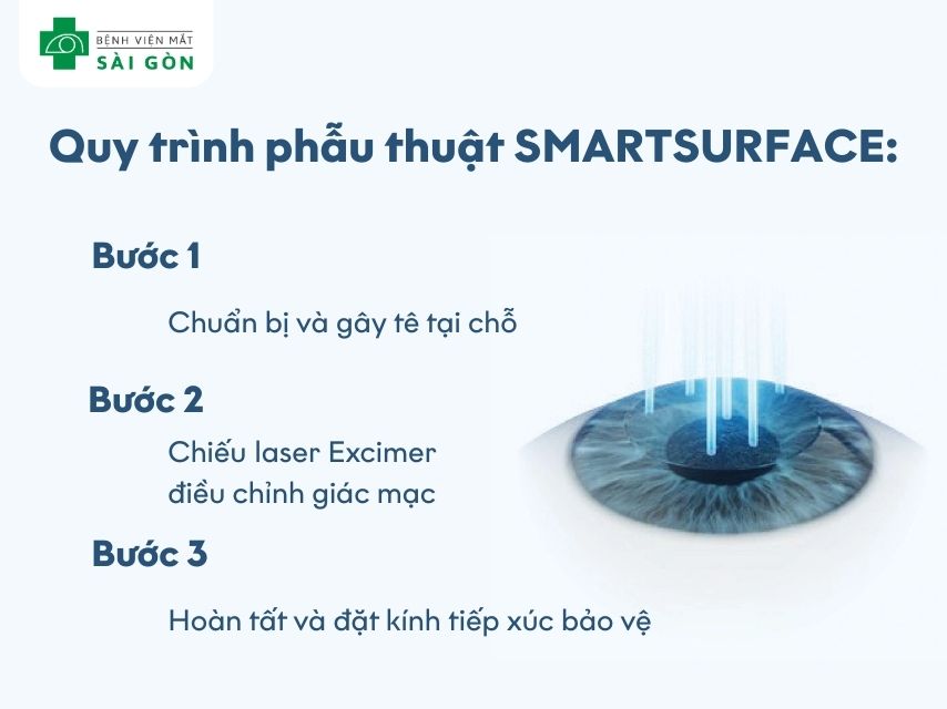Quy trình phẫu thuật SMARTSURFACE tại Mắt Sài Gòn