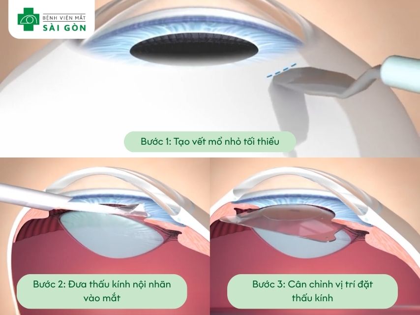 Phẫu thuật PHAKIC trải qua 3 bước