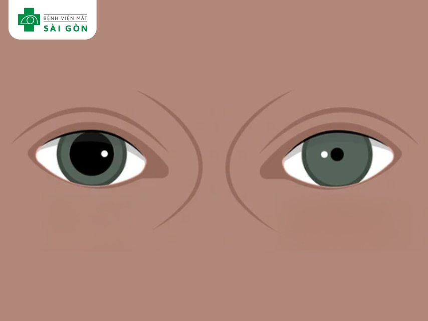 Chấn thương khiến hai đồng tử kích thước khác nhau