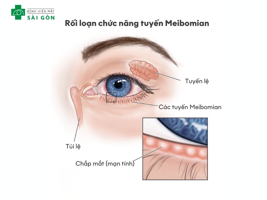 Rối loạn tuyến Meibomian gây khô mắt