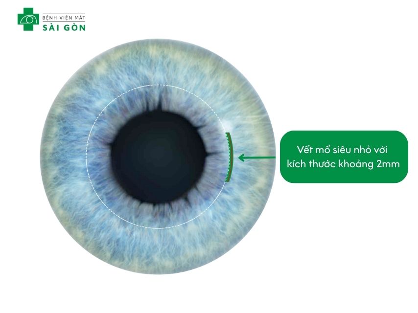 Phẫu thuật LASIK với phương pháp SMILE Pro