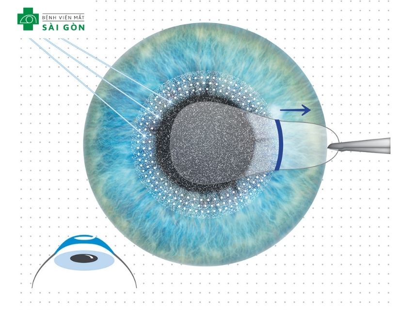 Phẫu thuật LASIK với phương pháp SMILE