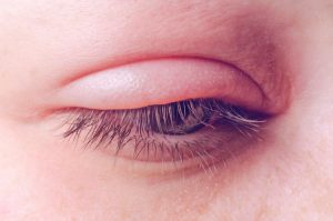 Sưng mi mắt, một số nguyên nhân và cách khắc phục sưng mi mắt