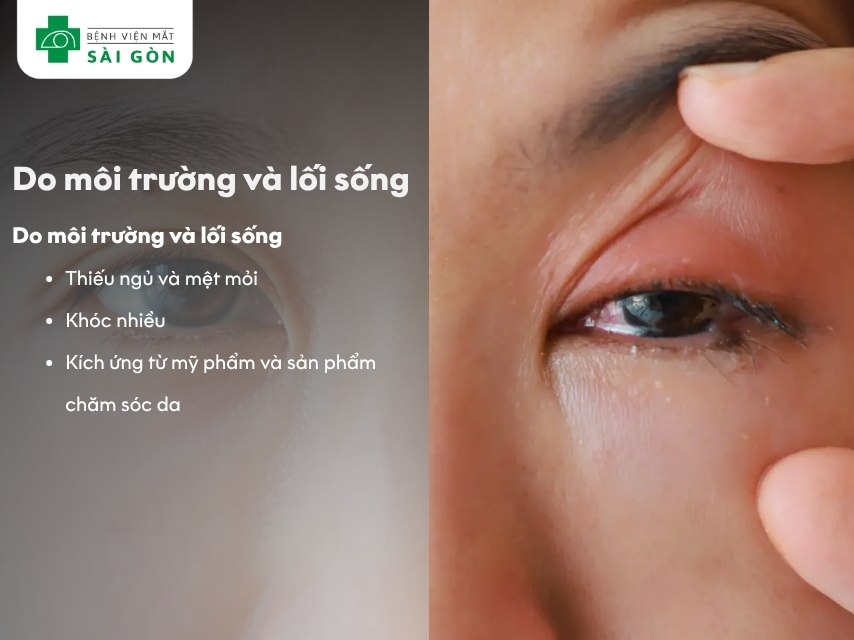 Sưng mí mắt do môi trường và lối sống