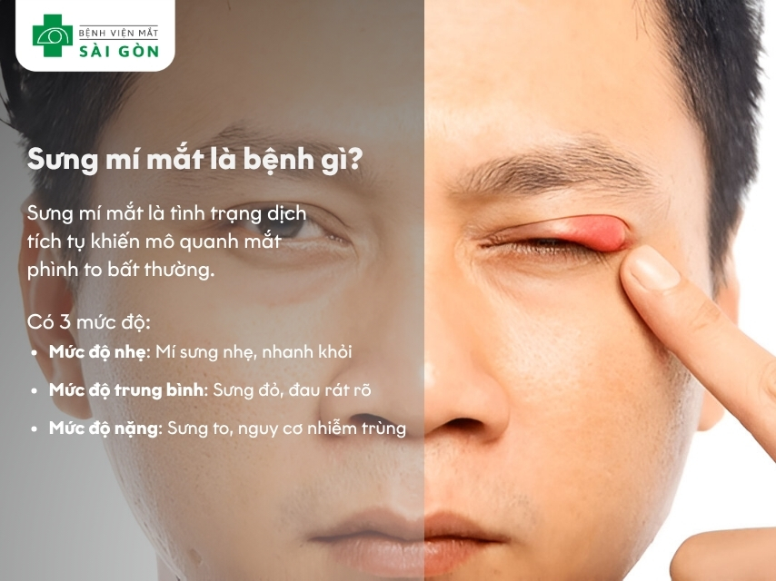 Sưng mí mắt là bệnh gì?