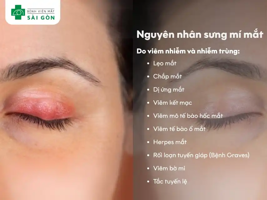 Các nguyên nhân gây lẹo mắt do viêm nhiễm và nhiễm trùng
