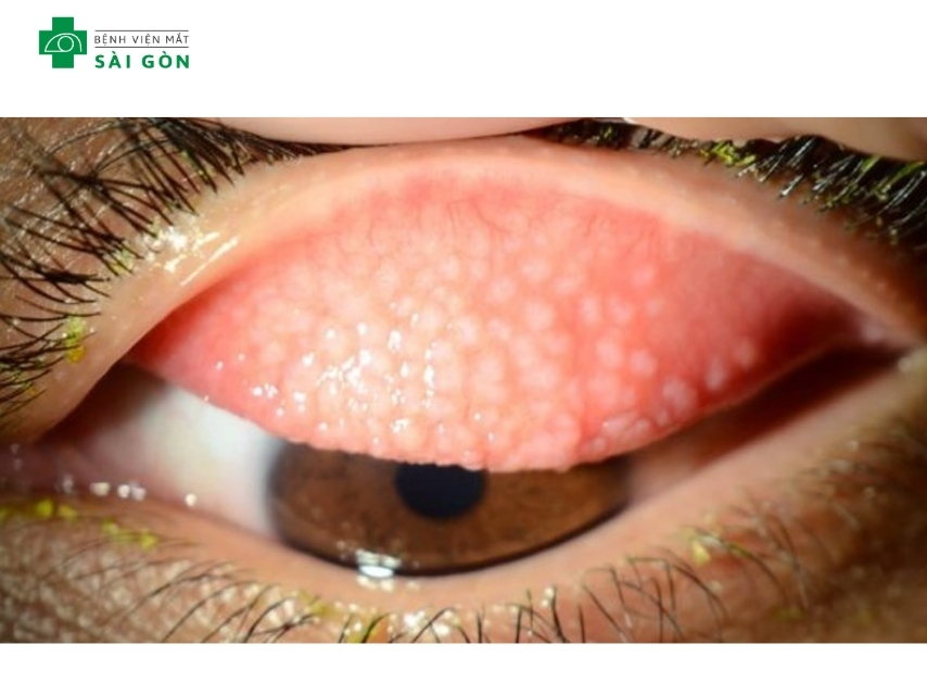 Vi khuẩn Chlamydia trachomatis gây ra đau mắt hột