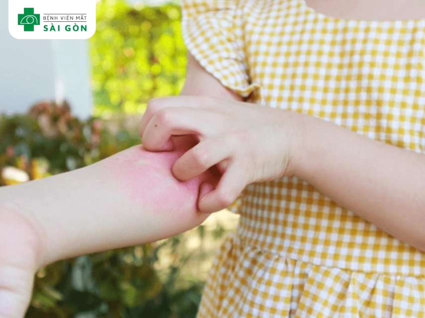 Virus có thể lây lan sang các vùng da khác do hành động cào và nặn mụn