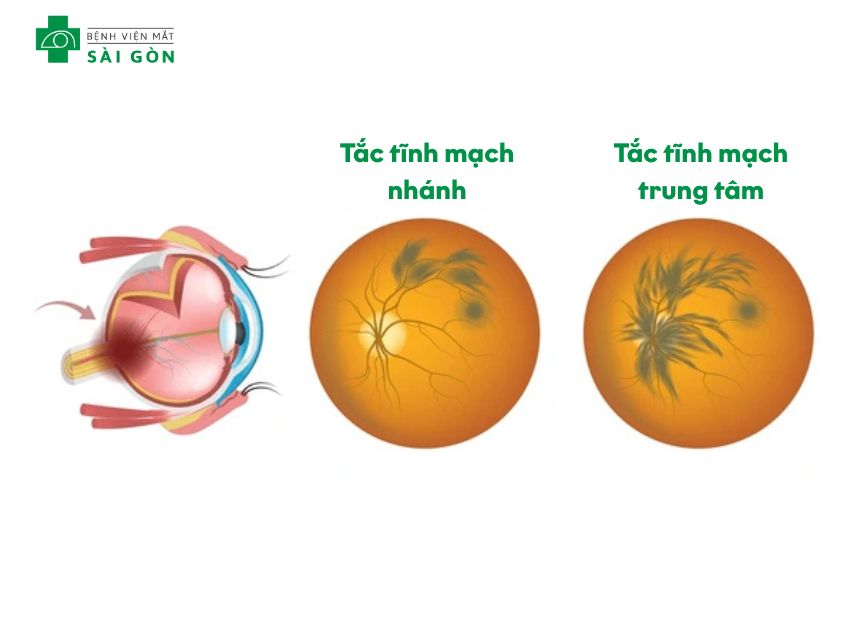 Tắc tĩnh mạch võng mạc