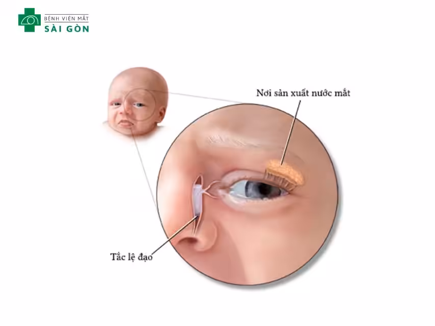 Tắc tuyến lệ ở trẻ sơ sinh là gì