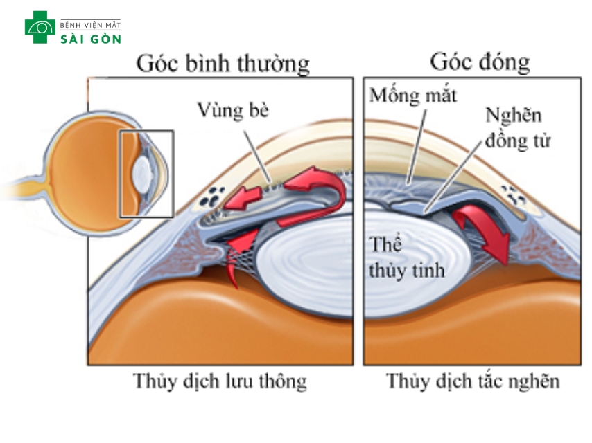 Glôcôm góc đóng cấp tính gây tăng nhãn áp do mống mắt chặn đường thoát thủy dịch