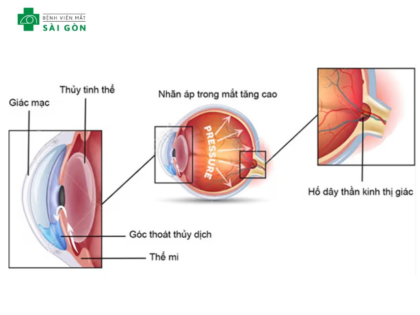 Tăng nhãn áp gây mất thị lực một phần