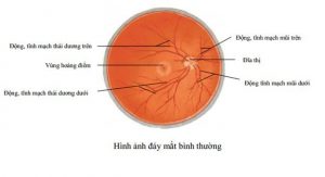 Tăng sinh dịch kính võng mạc: Bệnh dễ gây mù lòa tăng sinh dịch kính võng mạc