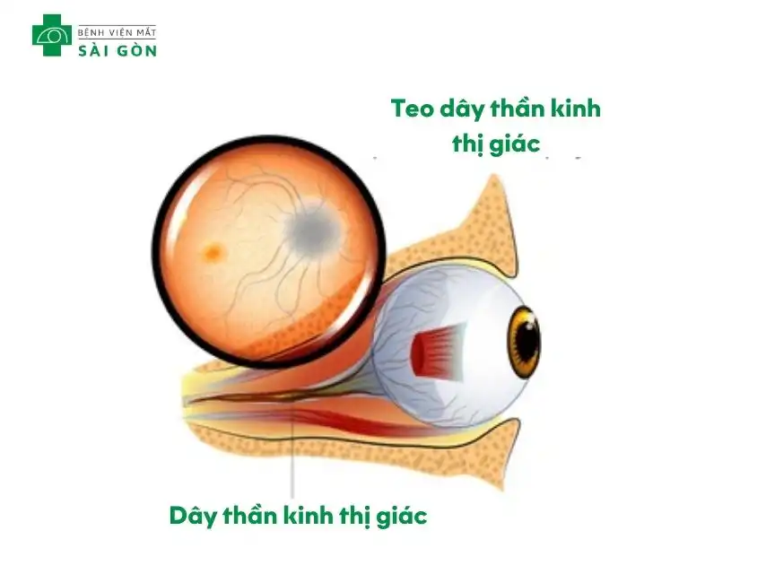 Teo dây thần kinh thị giác