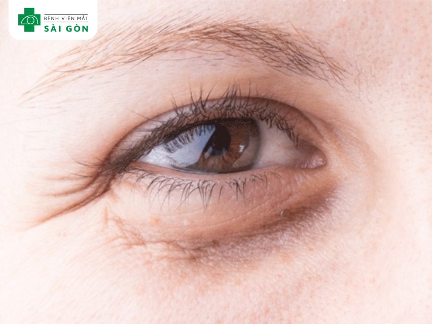 Quầng thăm mắt xuất hiện do lão hóa