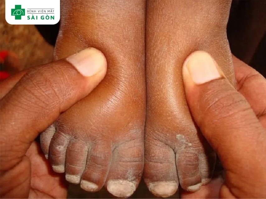 Thiếu vitamin B1 gây tổn thương thần kinh