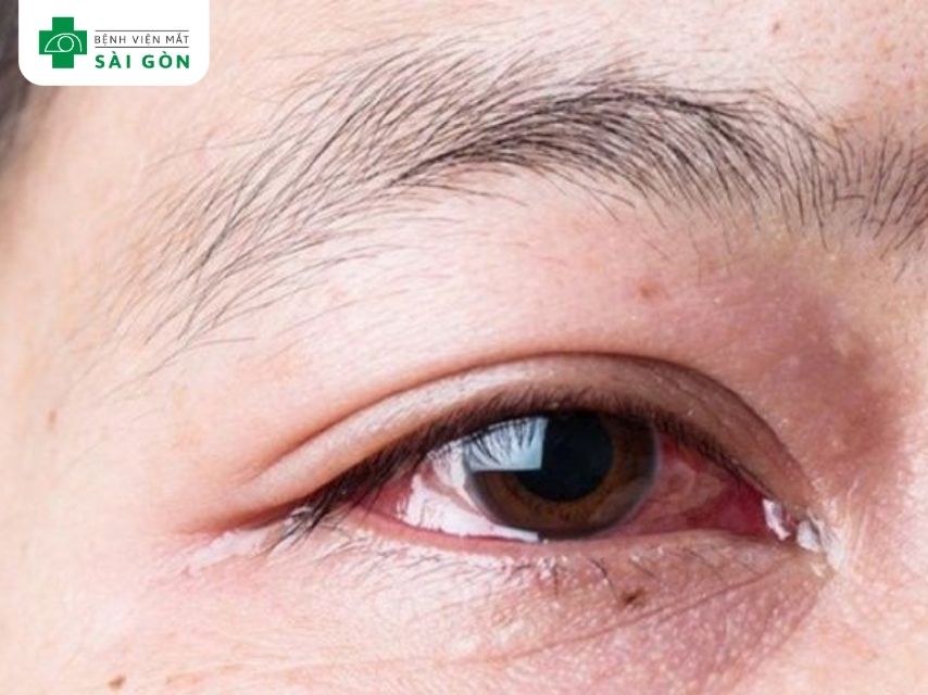 Thiếu vitamin B2 ảnh hưởng thị lực và làn da