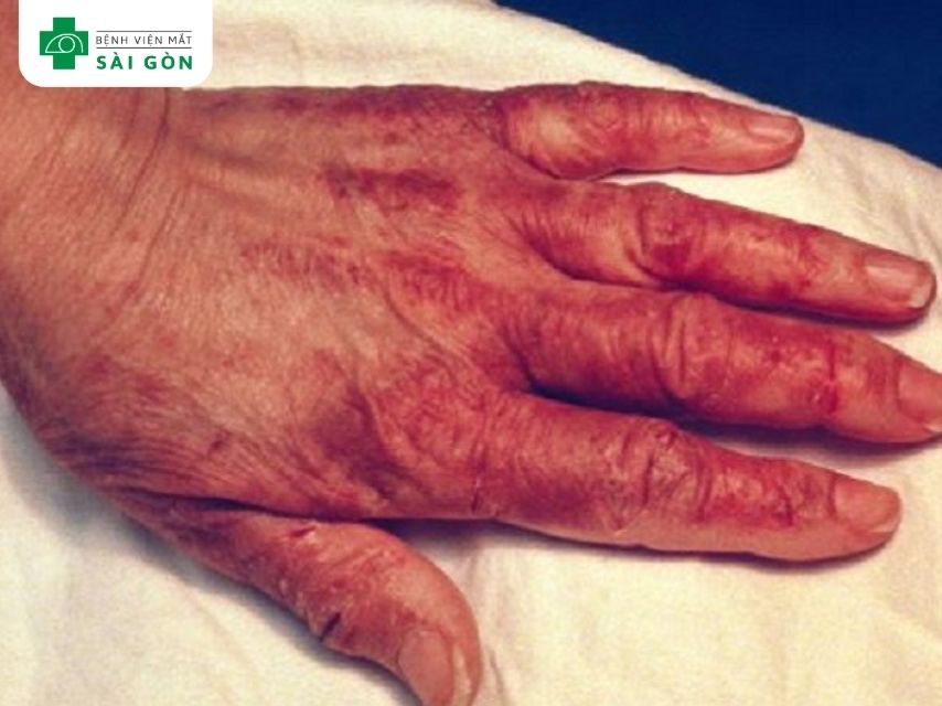 Thiếu vitamin B3 (Niacin)