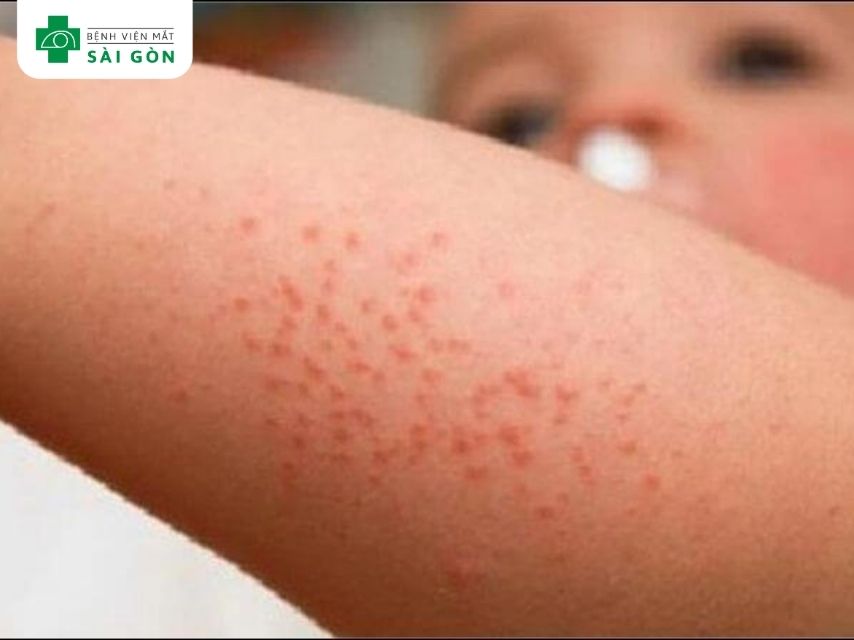 Thiếu vitamin B6 gây rối loạn da