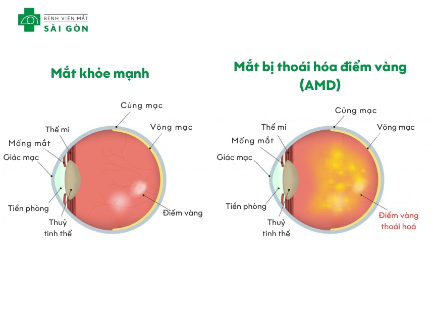 Tổng quan thoái hóa điểm vàng