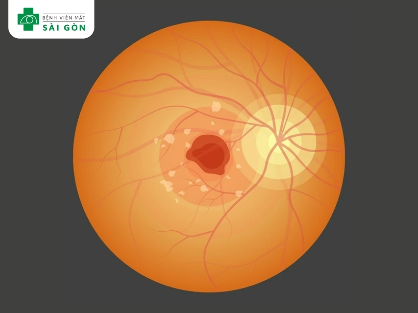 Thoái hóa điểm vàng thể ướt do mạch máu bất thường dưới điểm vàng