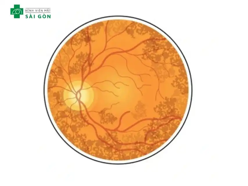 Thoái hóa sắc tố võng mạc hay Retinitis Pigmentosa (RP)