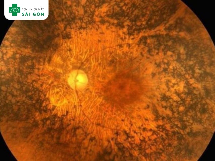 Thoái hóa võng mạc vùng chu biên