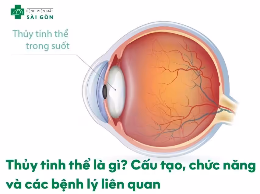 Thủy tinh thể là gì