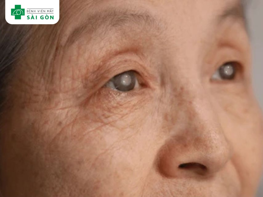 Tổn thương mắt do tia UV