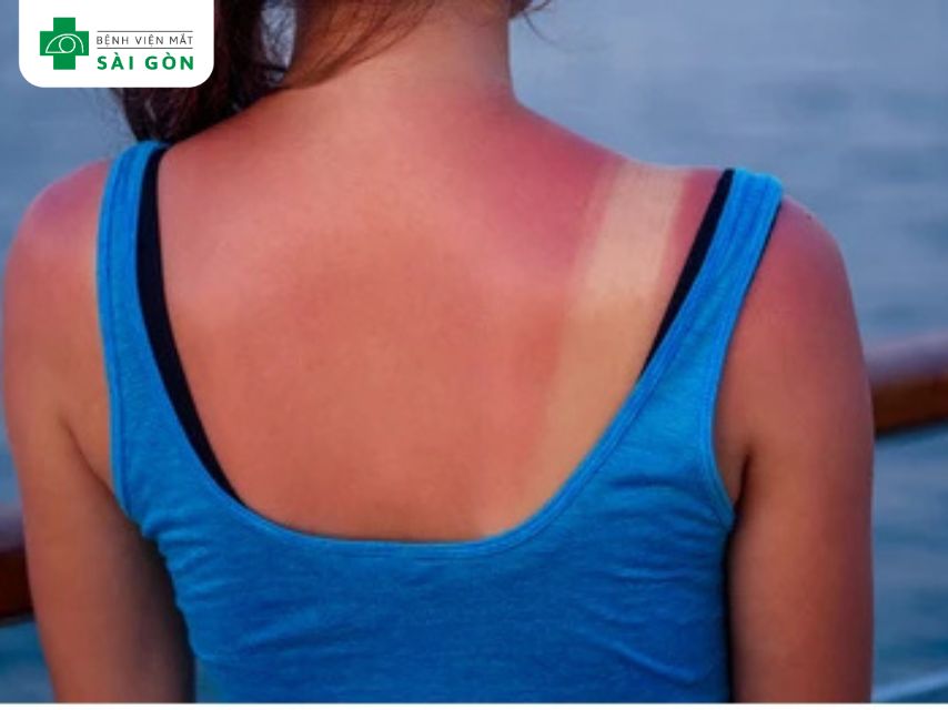 Ung thư da (Skin Cancer)