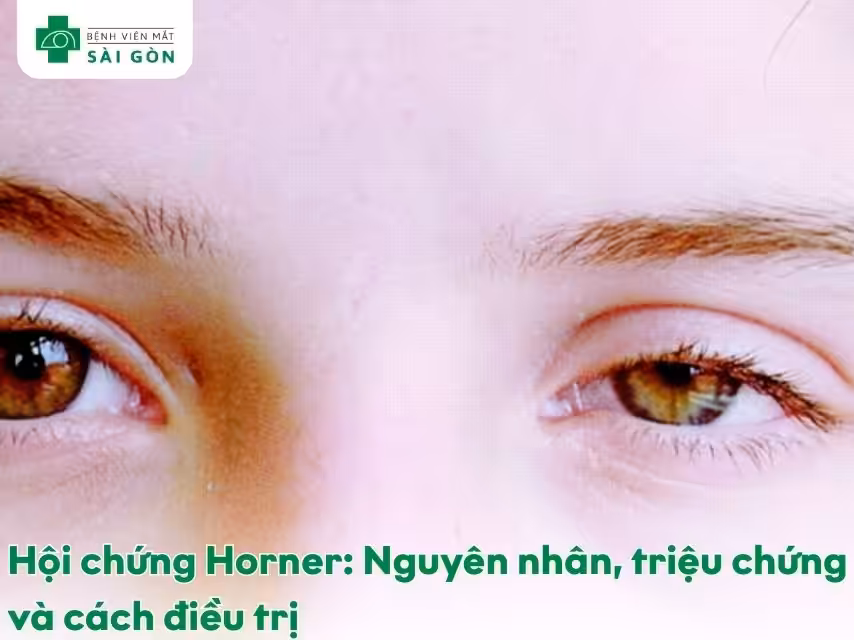 Hội chứng Horner là gì