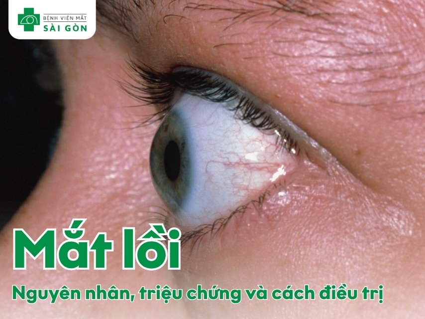 Tổng quan về bệnh lý mắt lồi