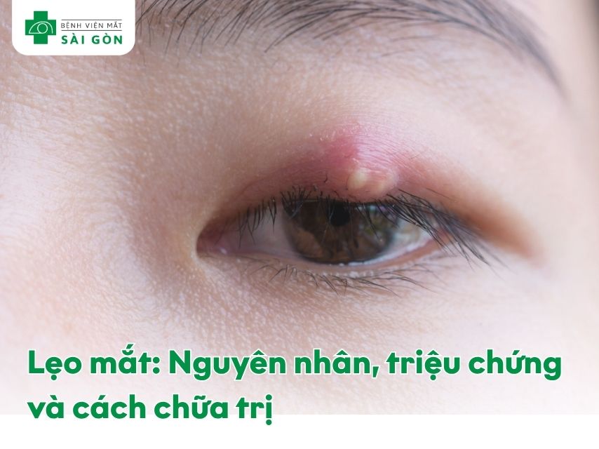 Mắt bị lẹo với khối sưng đỏ ở mí mắt
