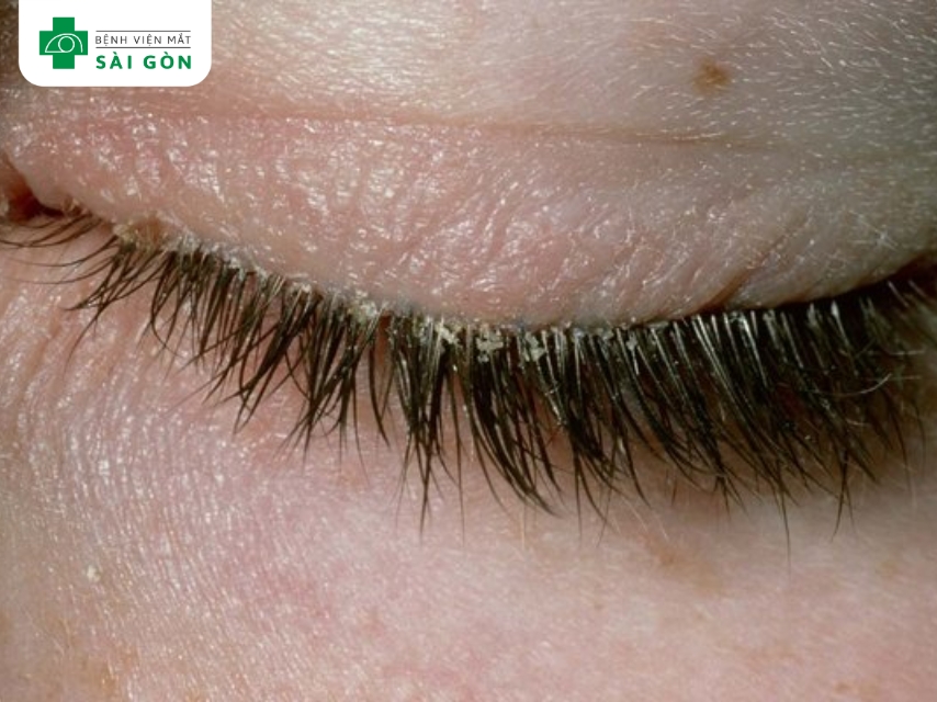 Viêm bờ mi là viêm mãn tính tại bờ mi