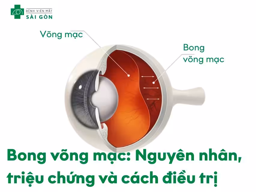 Nguyên nhân, triệu chứng bong võng mạc