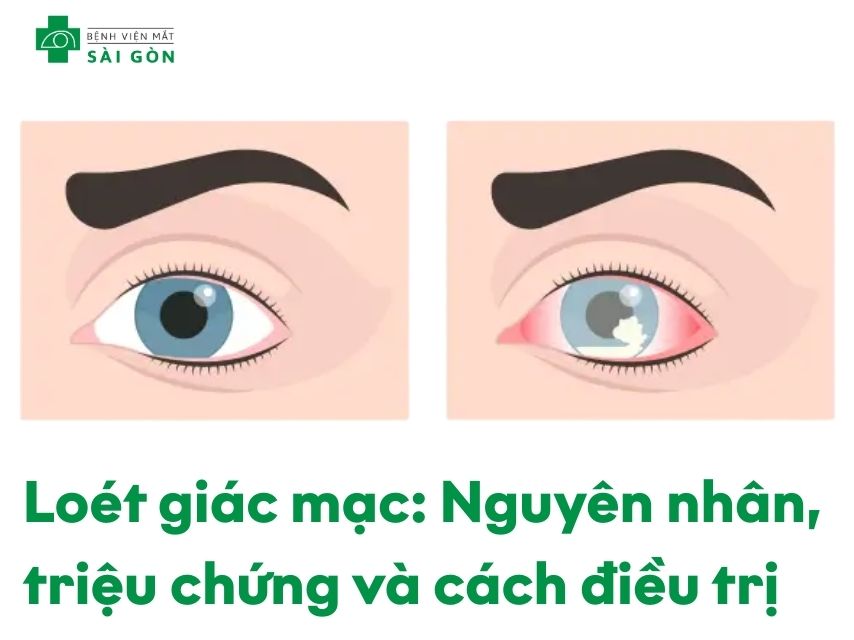 Tình trạng loét giác mạc