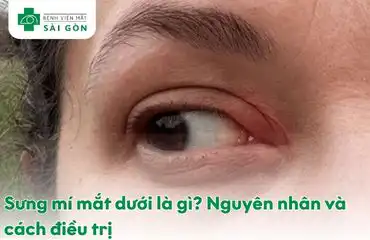 Sưng mí mắt dưới là gì