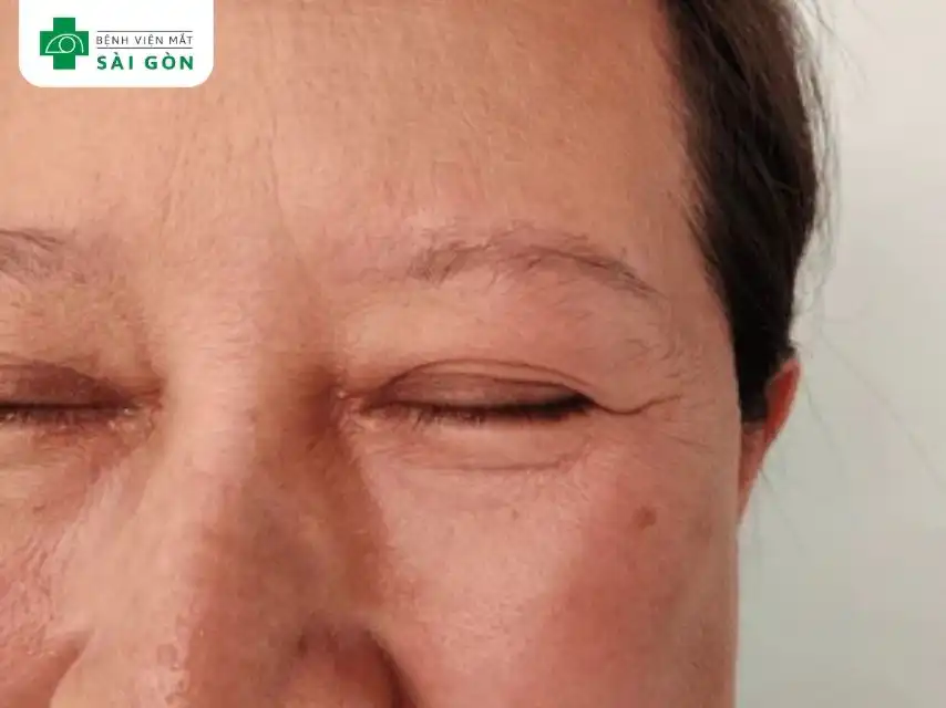 Sưng mí mắt dưới là tình trạng mí mắt dưới bị viêm