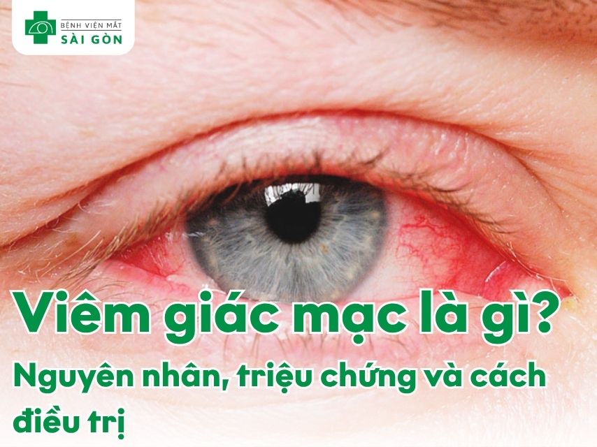 Viêm giác mạc gây đau nhức, đỏ mắt, chảy nước mắt, giảm thị lực