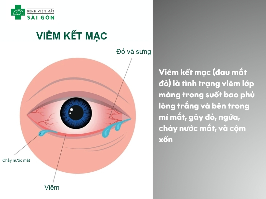 Viêm kết mạc là bệnh lý gì và đặc điểm.