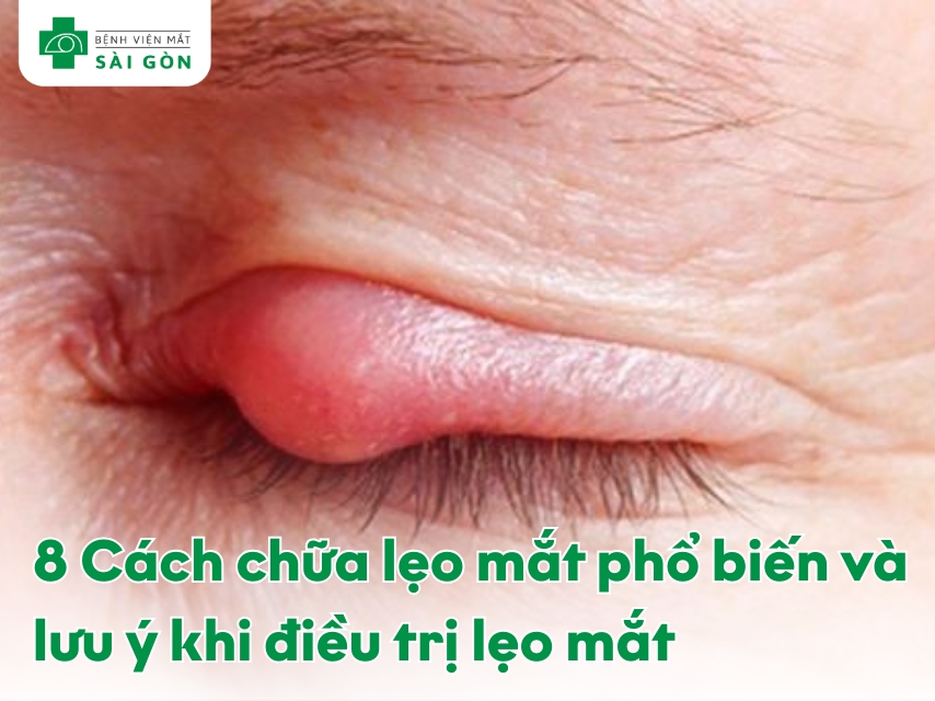 8 cách chữa lẹo mắt phổ biến