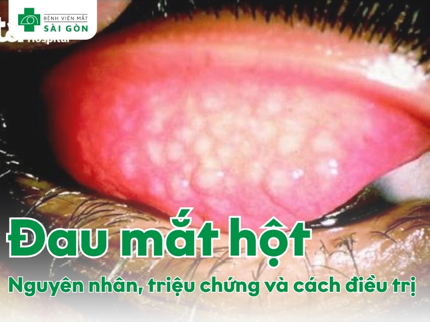 Tìm hiểu về bệnh đau mắt hột