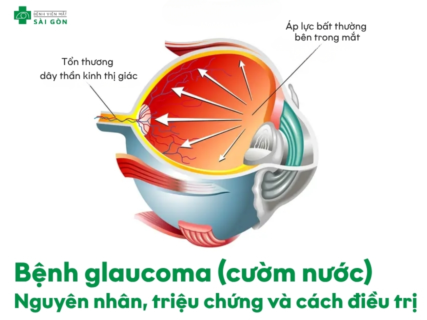 Tìm hiểu tổng quan bệnh glaucoma