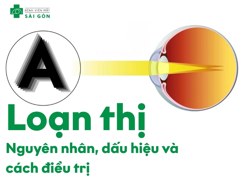 Tổng quan về loạn thị