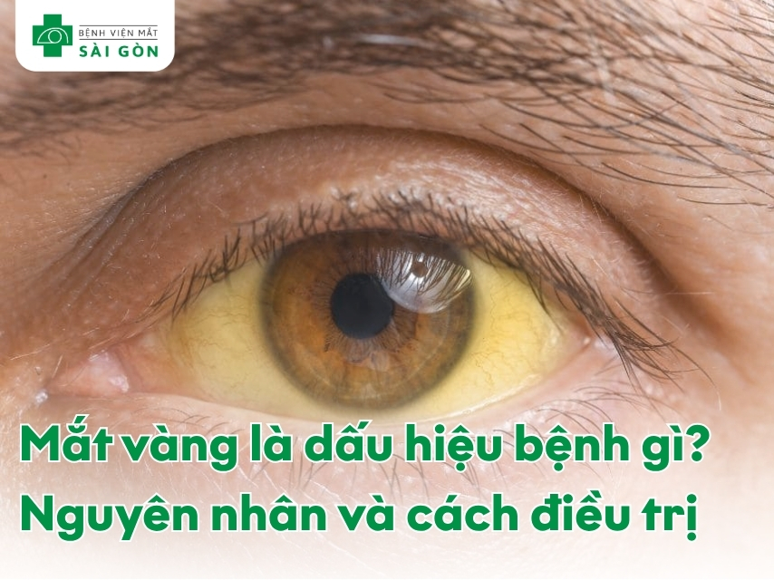 Mắt vàng là bệnh gì và nguyên nhân