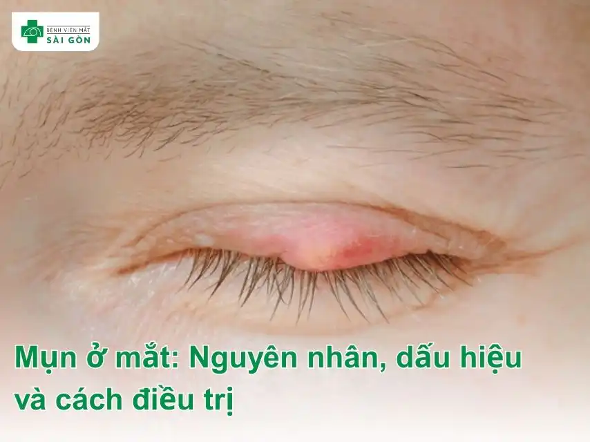 Mụn ở mắt là bệnh lý thường gặp