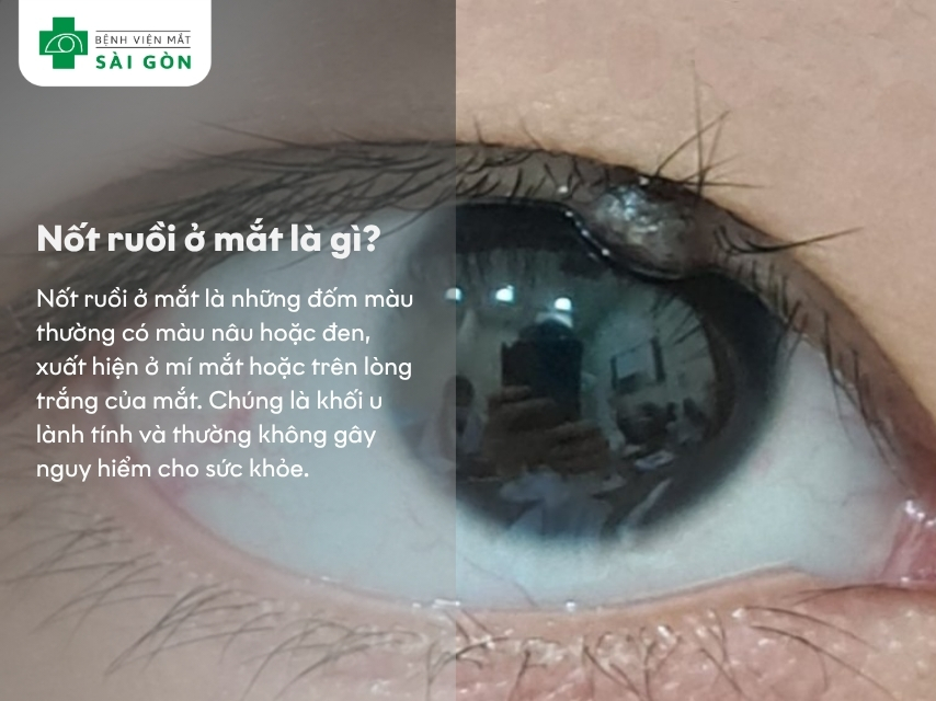 Ý nghĩa của nốt ruồi ở mắt và khi nào cần xử lý