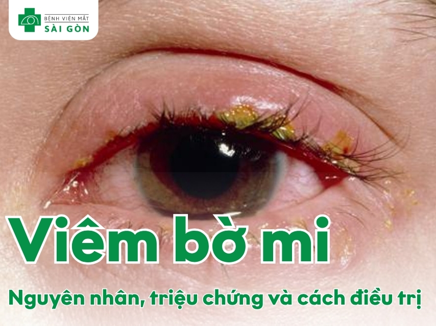 Tổng quan viêm bờ mi
